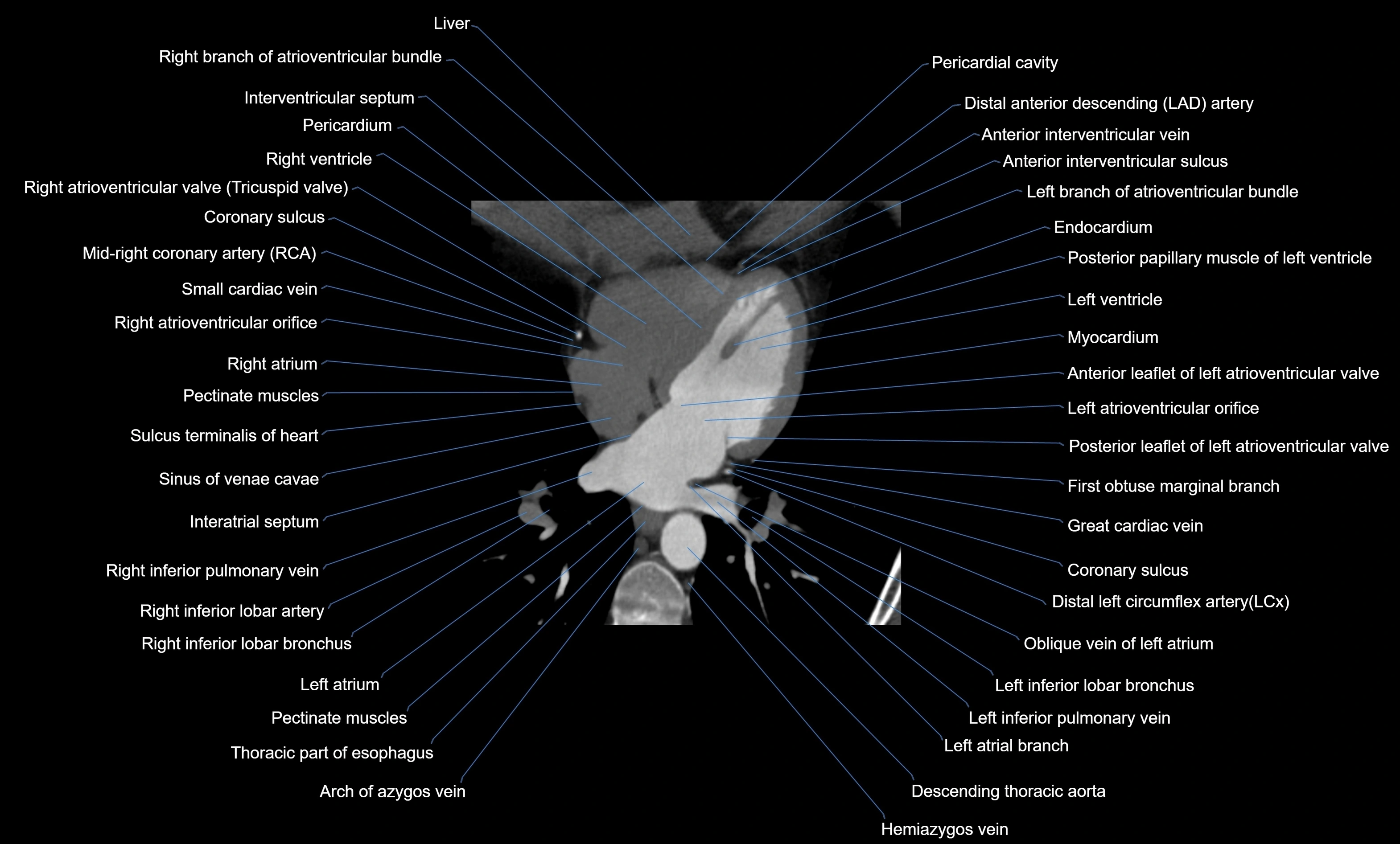 CT heart (coronary angiogram) four chamber view  cross sectional anatomy labelled radiology image -00033.webp